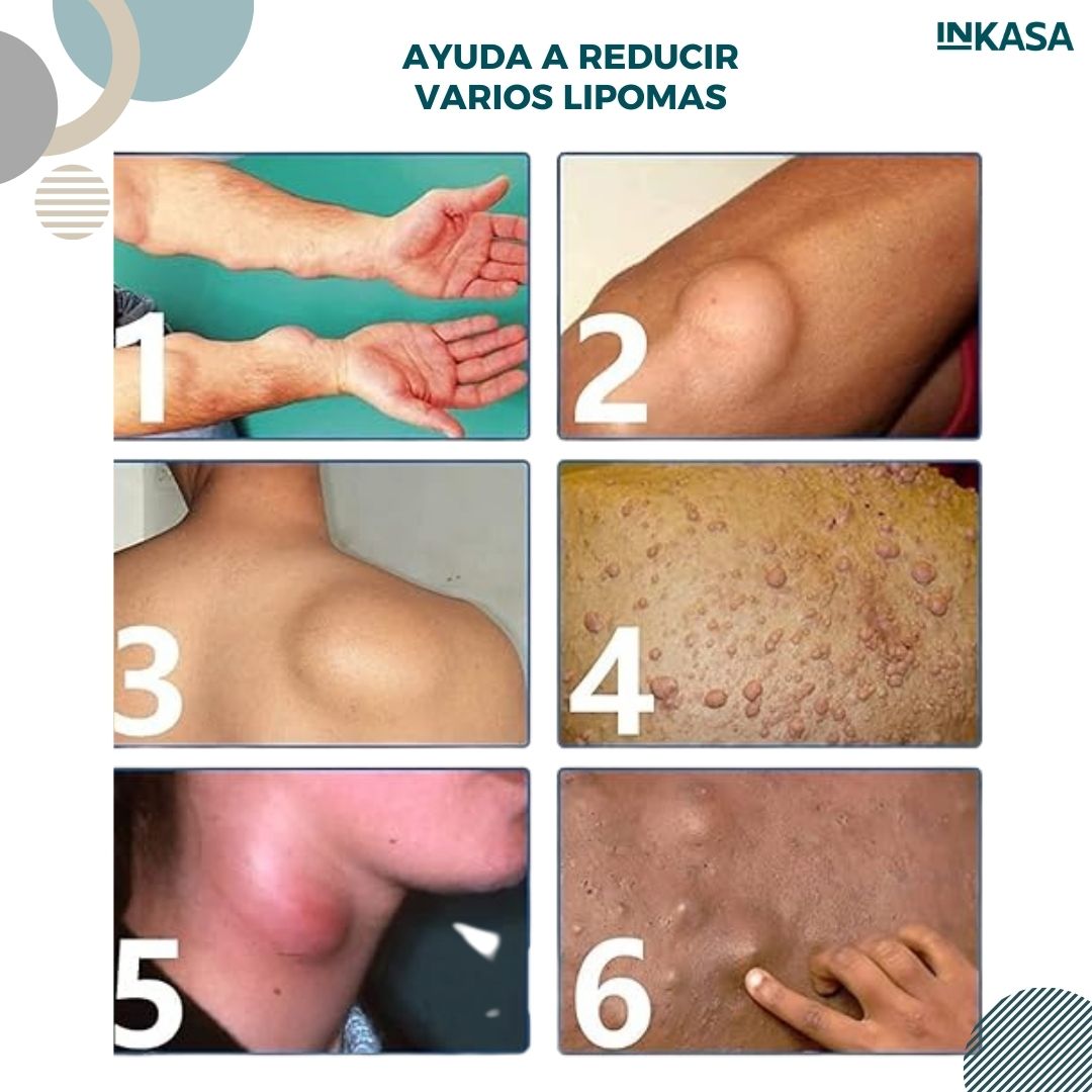 Spray Mágico Anti-Lipomas