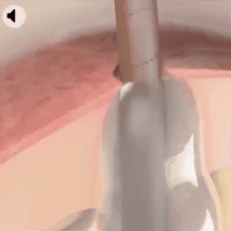 Spray Mágico Anti-Lipomas